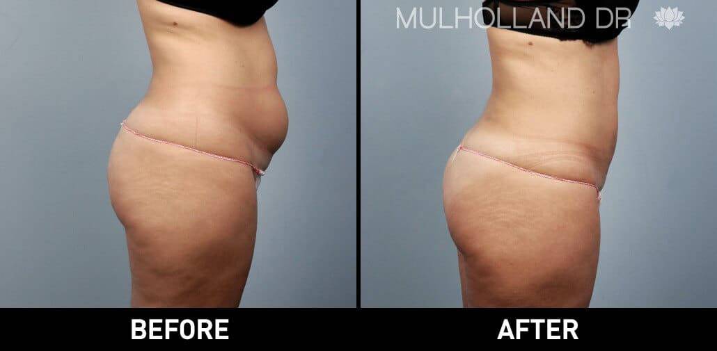 SmartLipo - Before and After Gallery - Patient Photo 23