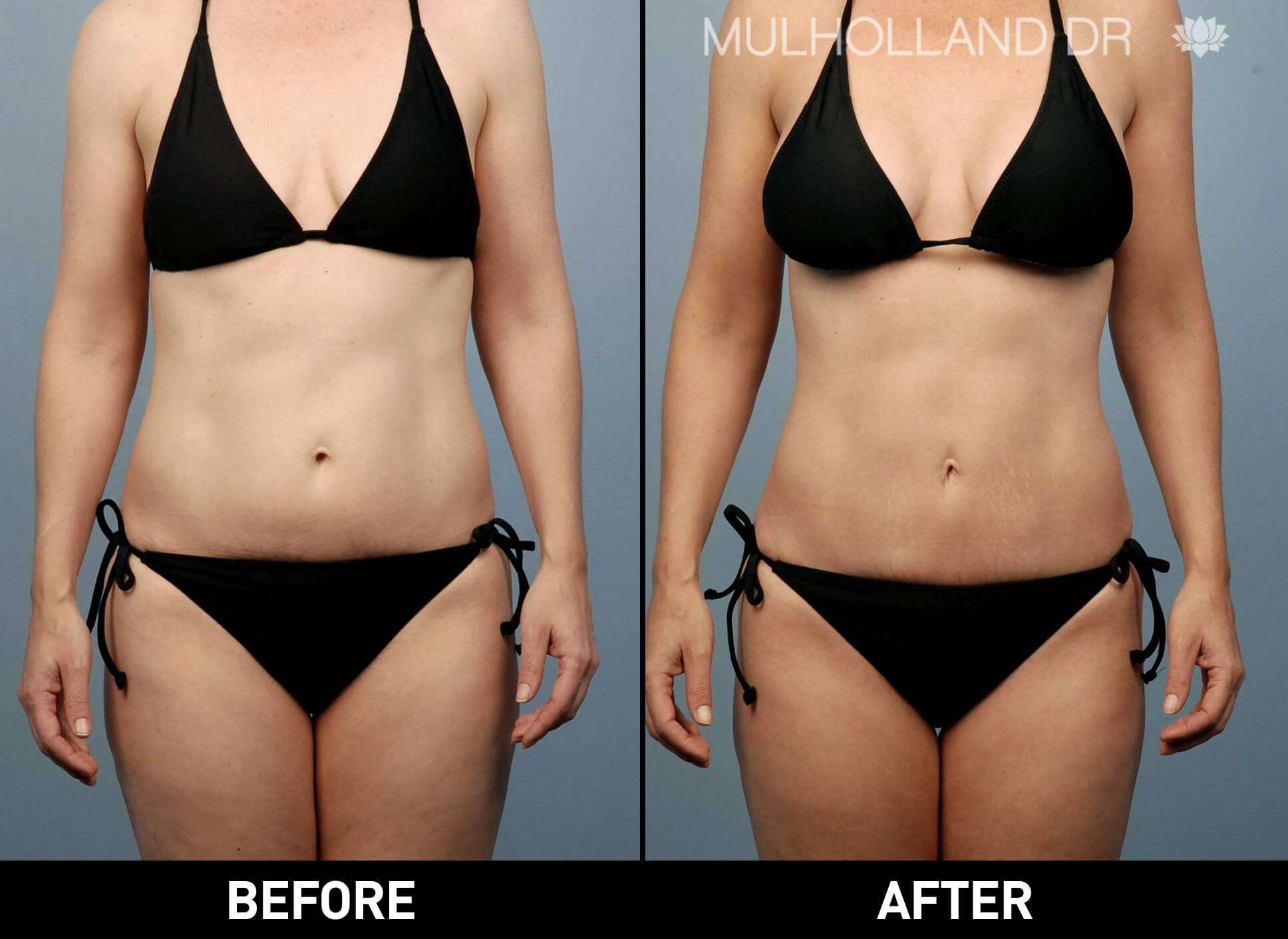 SmartLipo - Before and After Gallery - Patient Photo 4