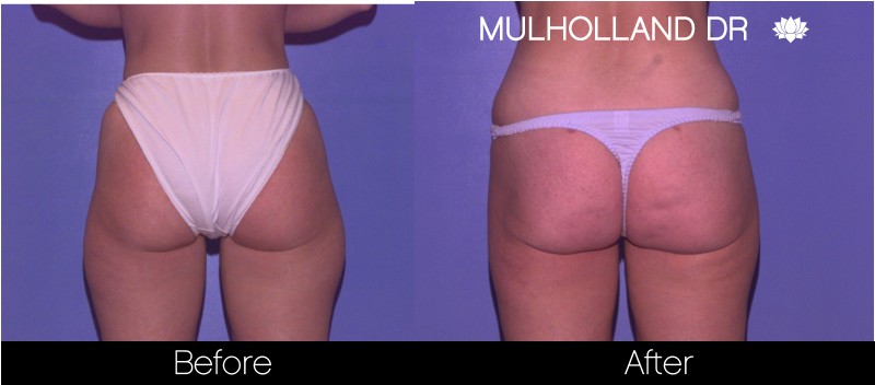 SmartLipo - Before and After Gallery - Patient Photo 59