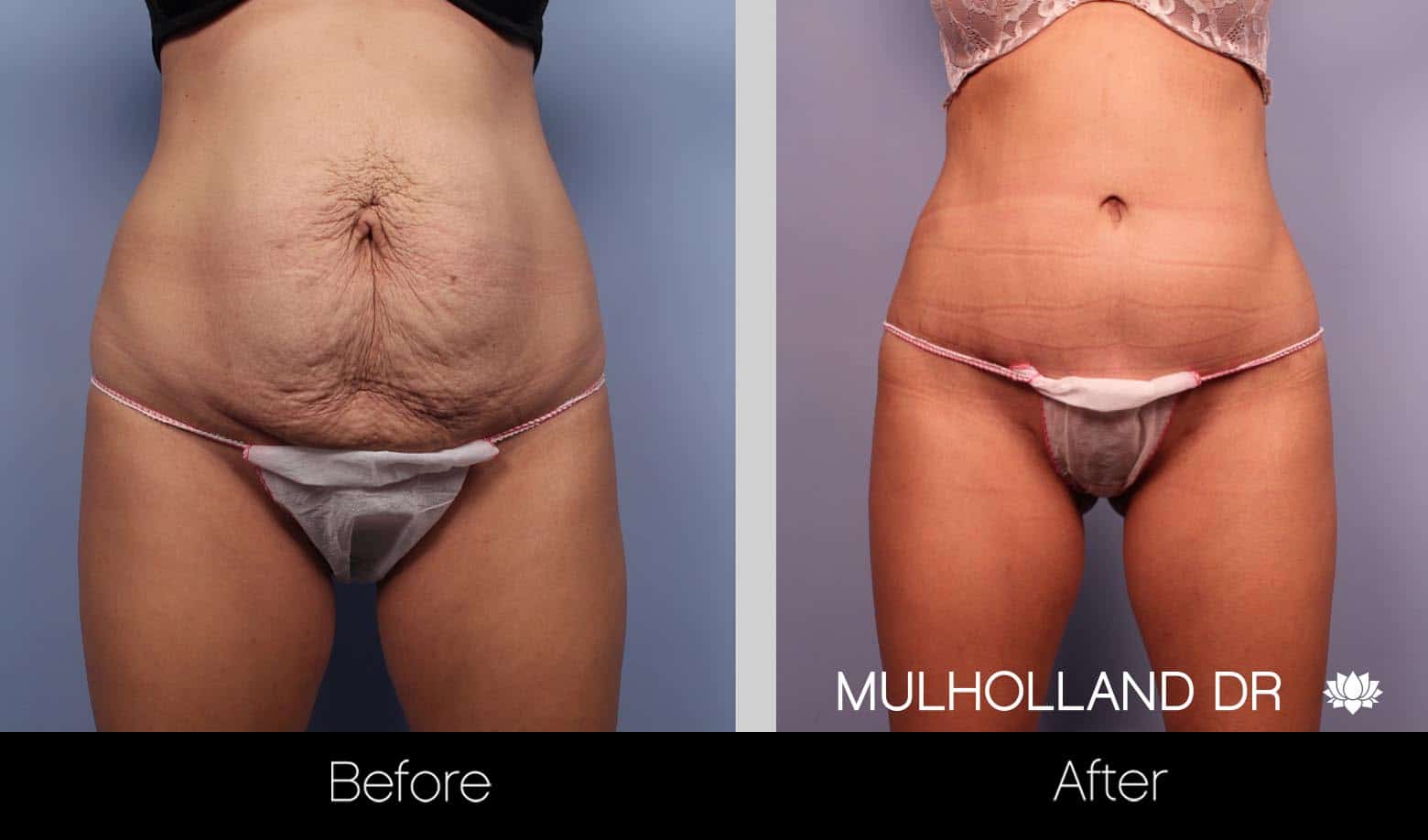 SmartLipo - Before and After Gallery - Patient Photo 7