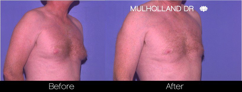 SmartLipo - Before and After Gallery - Patient Photo 77