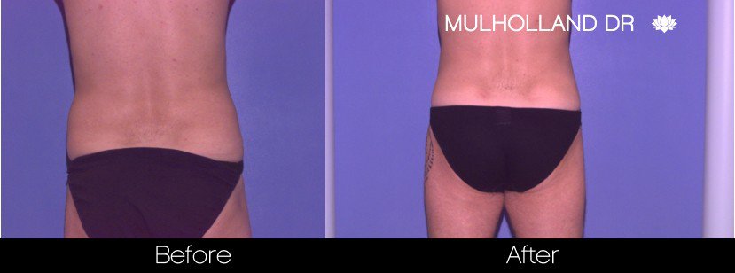 SmartLipo - Before and After Gallery - Patient Photo 84