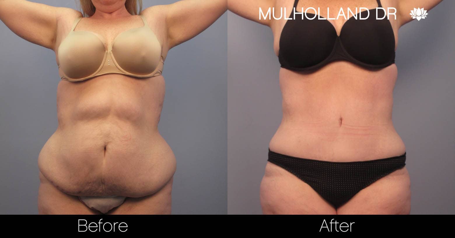 Tummy Tuck -Before and After Gallery - Patient Photo 1