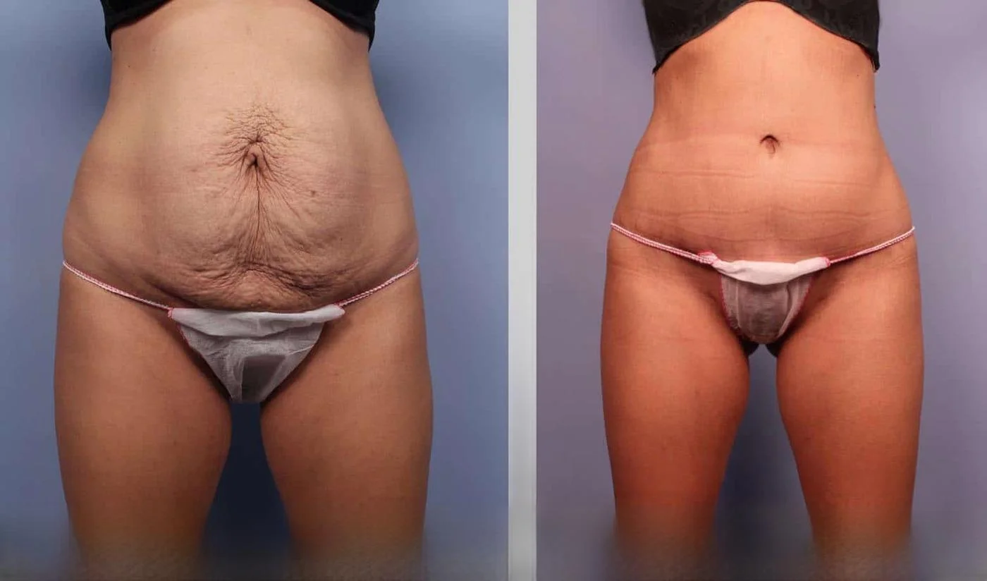 Tummy Tuck -Before and After Gallery - Patient Photo 22