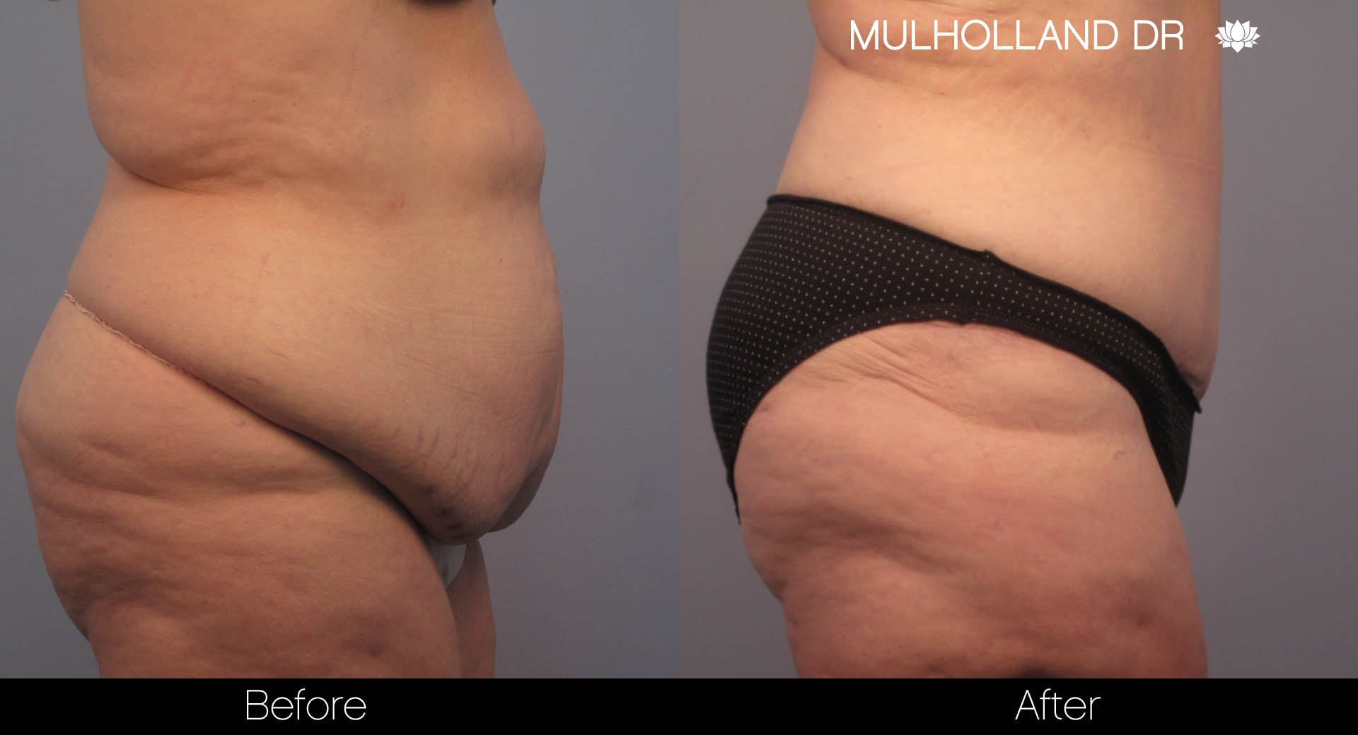 Tummy Tuck -Before and After Gallery - Patient Photo 5