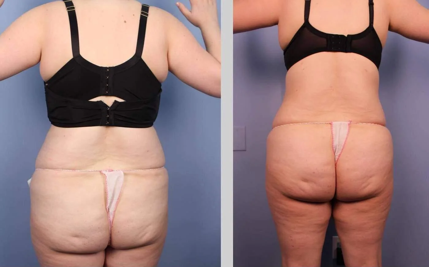 can you have lipo after a c section Patient Compares C-Section Pain To Tummy Tuck NYC Case #203