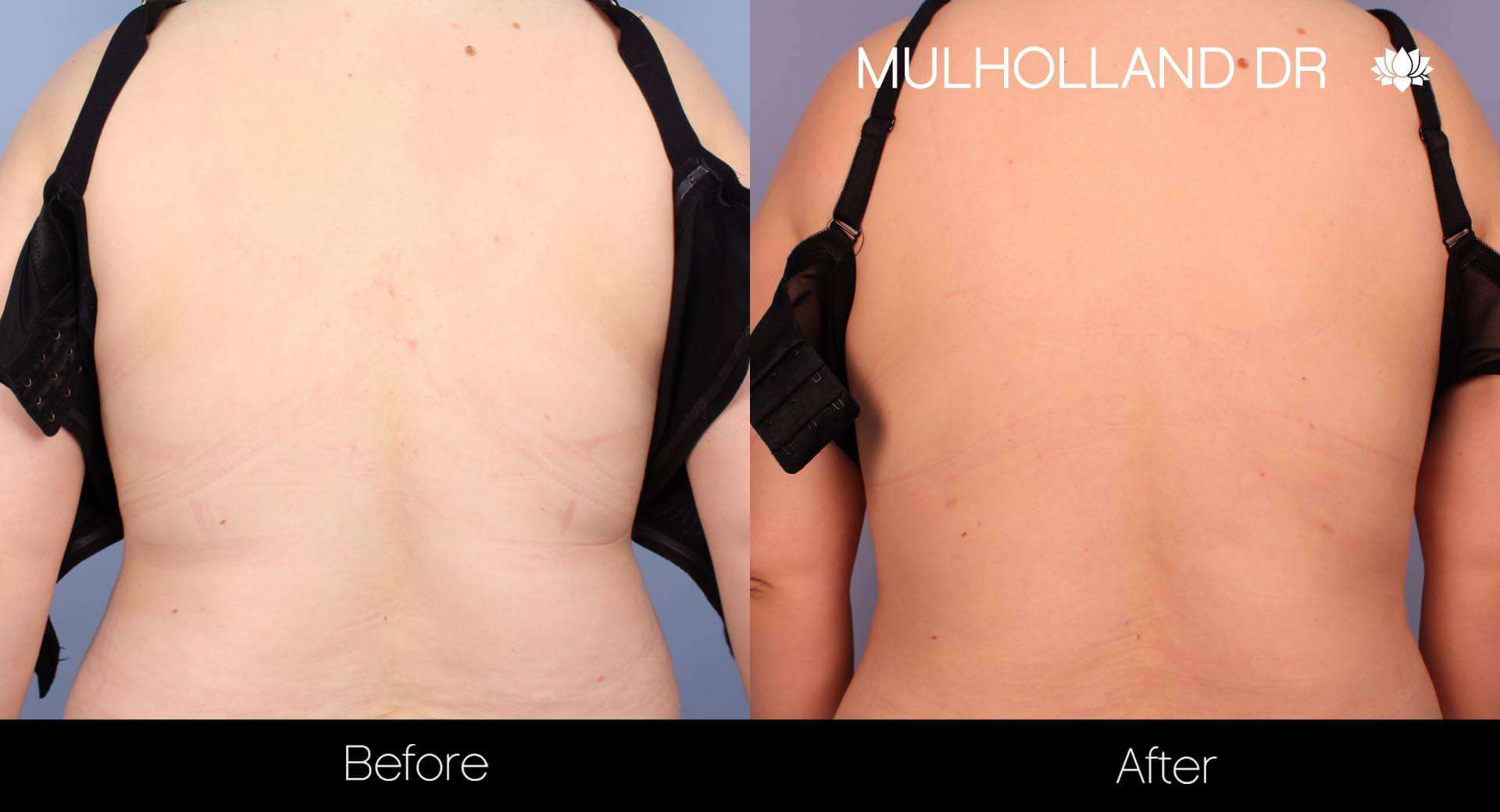 Vaser Liposuction - Before and After Gallery - Patient Photo 19