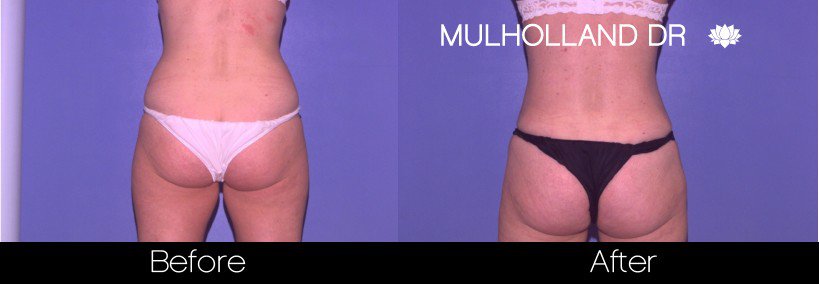 Vaser Liposuction - Before and After Gallery - Patient Photo 41