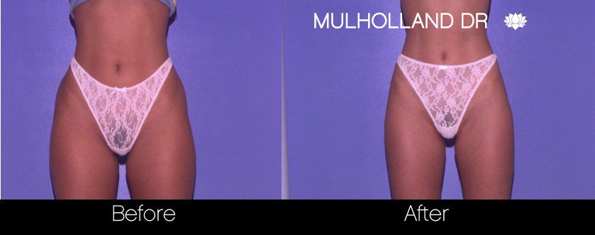 Vaser Liposuction - Before and After Gallery - Patient Photo 58