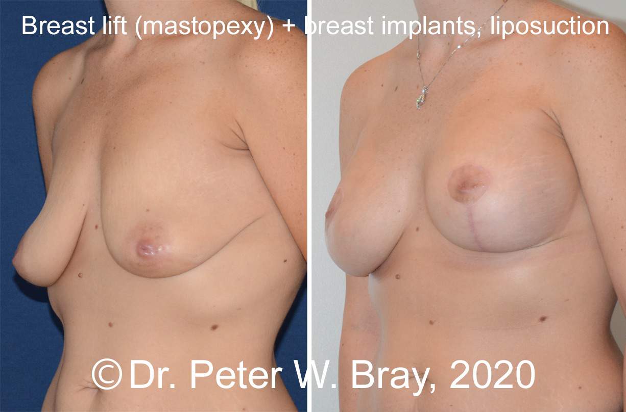 Breast Lift - Before and After Gallery – Photo 10