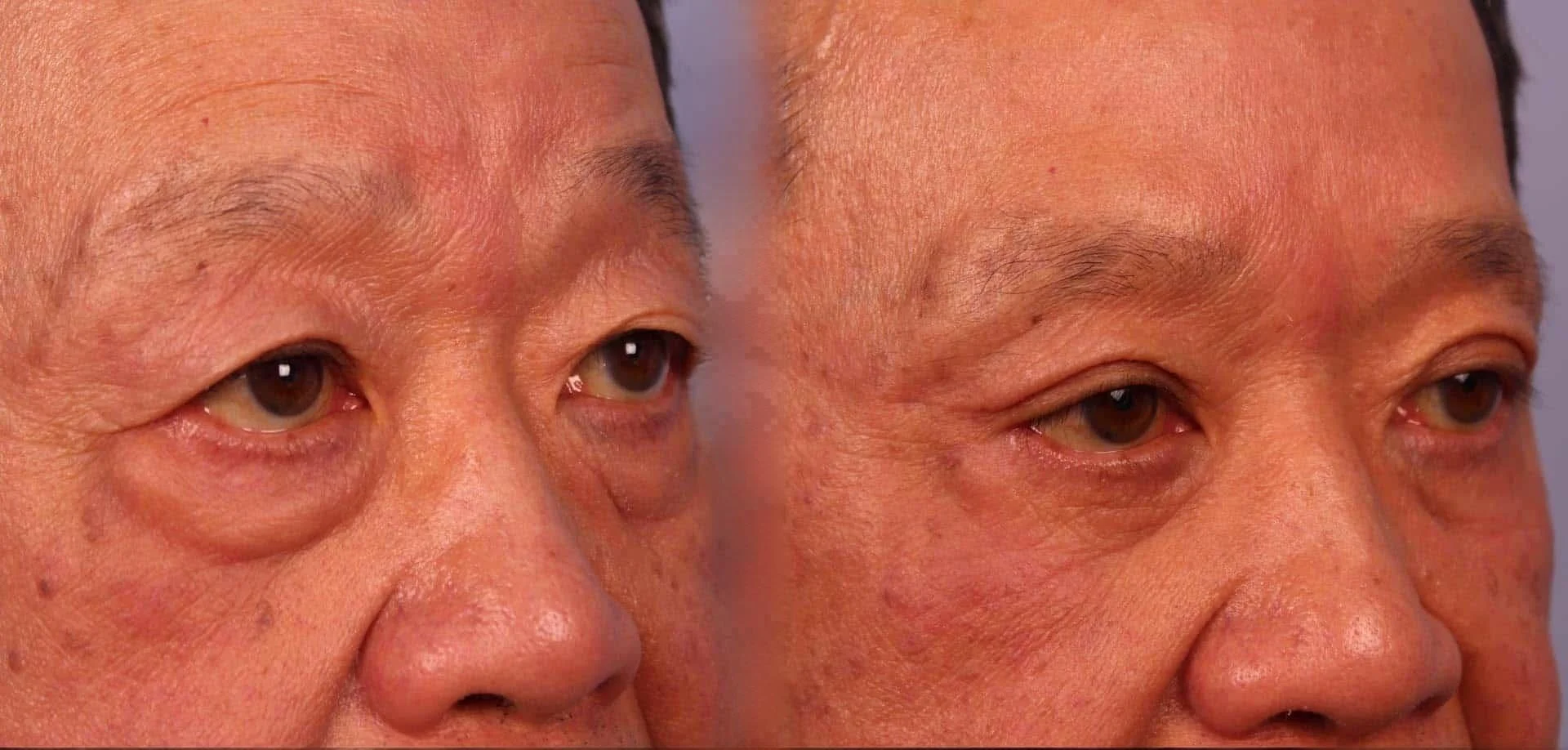 Male Blepharoplasty - Before and After Gallery – Photo 10