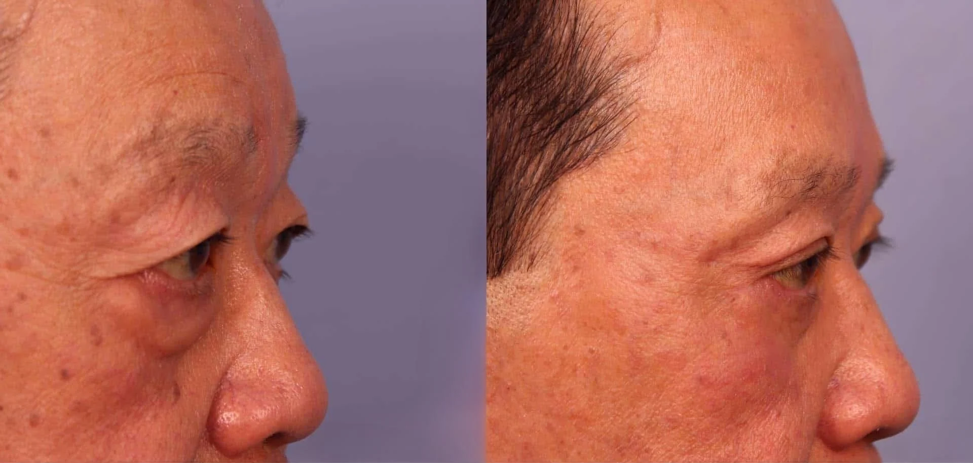 Male Blepharoplasty - Before and After Gallery – Photo 11