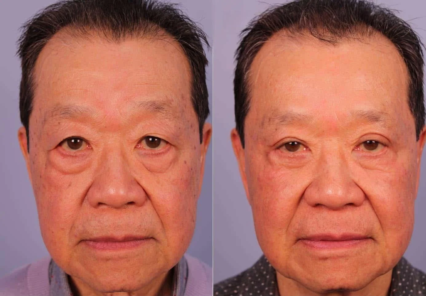 Male Blepharoplasty - Before and After Gallery – Photo 1