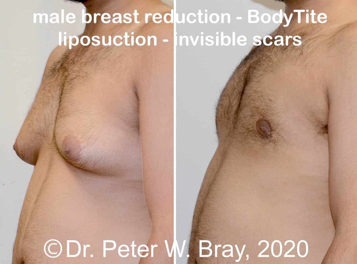 Male Breast Reduction - Before and After Gallery – Photo 1