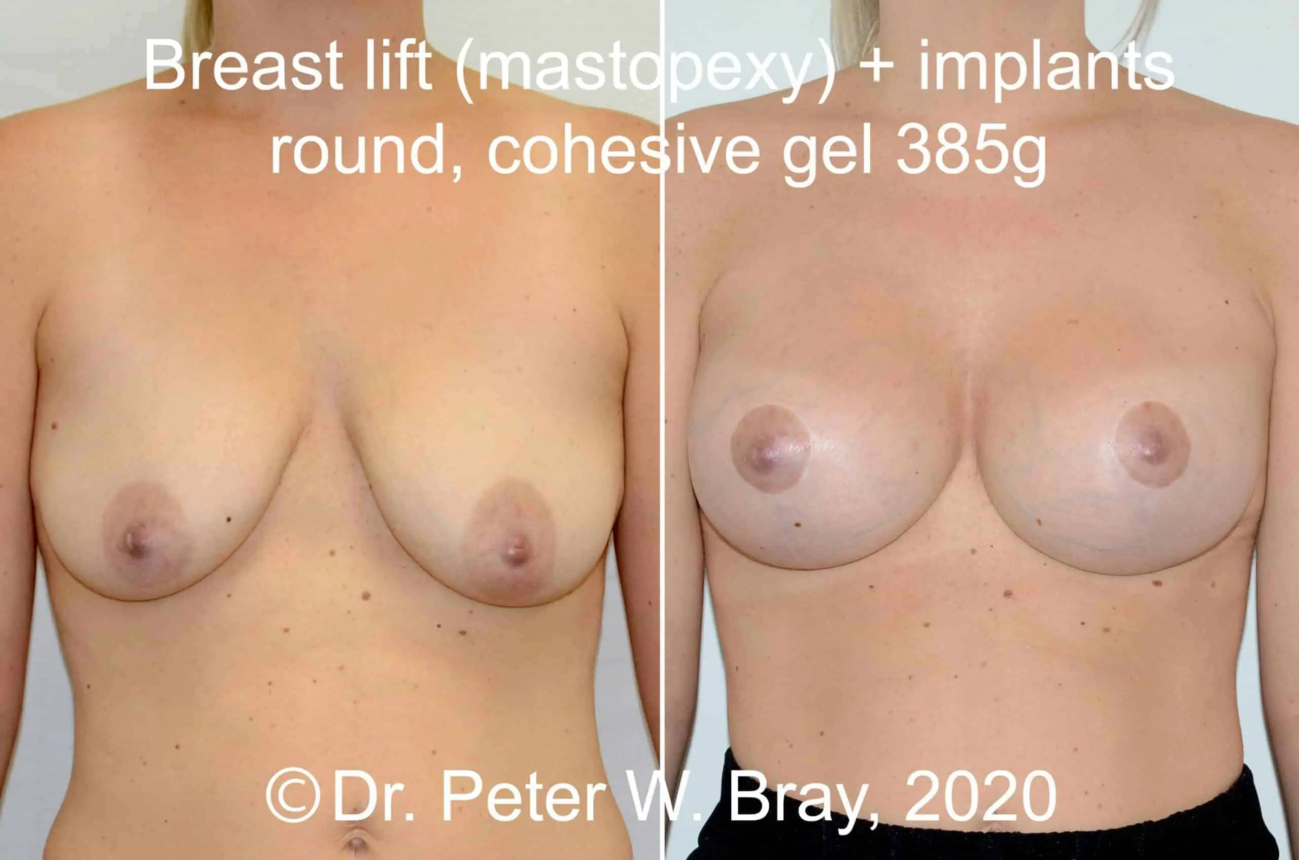 Breast Lift with Implants - Before and After Gallery – Photo 2