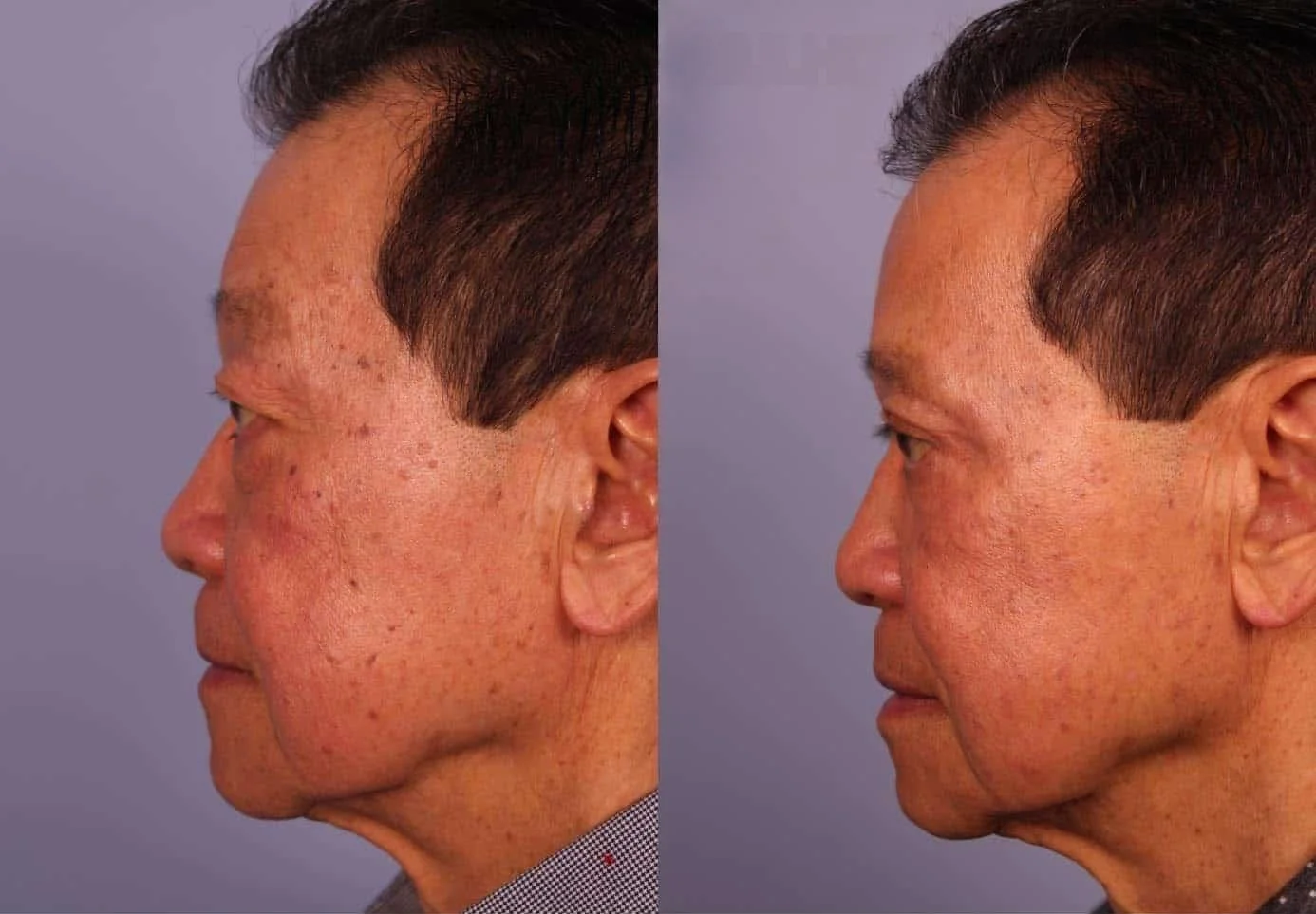 Male Blepharoplasty - Before and After Gallery – Photo 2