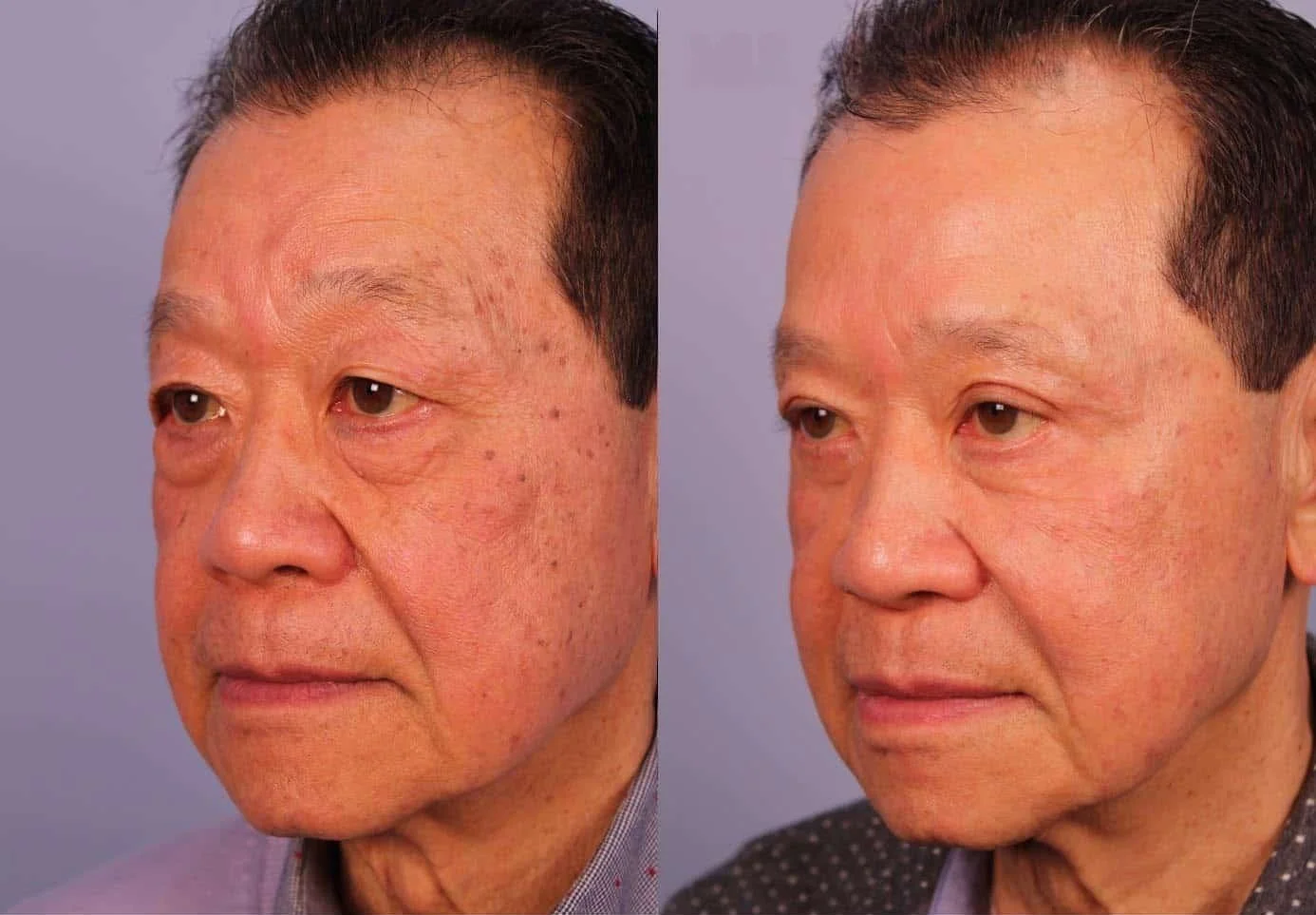 Male Blepharoplasty - Before and After Gallery – Photo 3