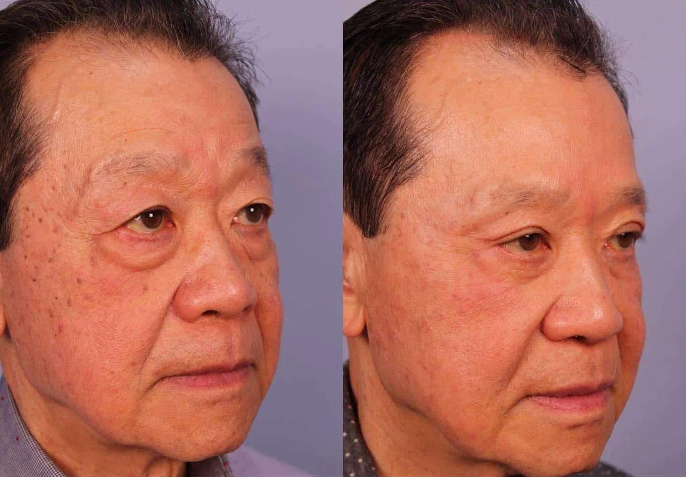 Male Blepharoplasty - Before and After Gallery – Photo 4