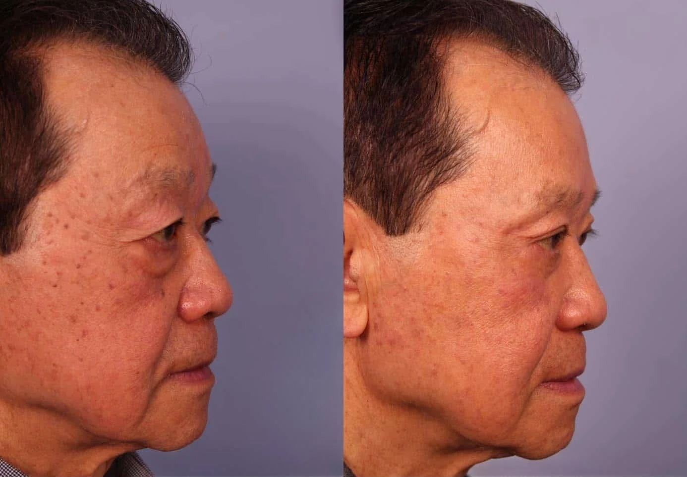 Male Blepharoplasty - Before and After Gallery – Photo 5