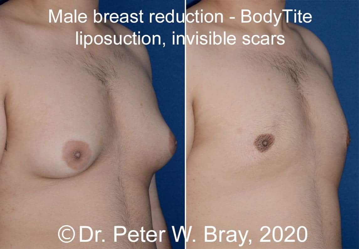 Male Breast Reduction - Before and After Gallery – Photo 5