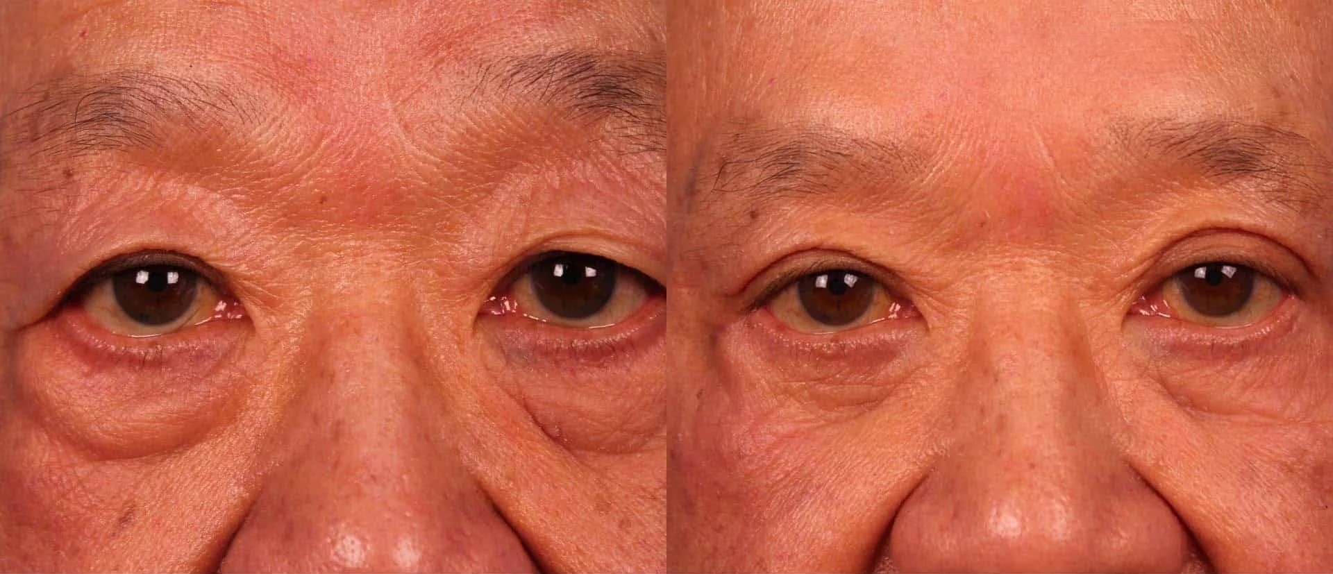 Male Blepharoplasty - Before and After Gallery – Photo 6
