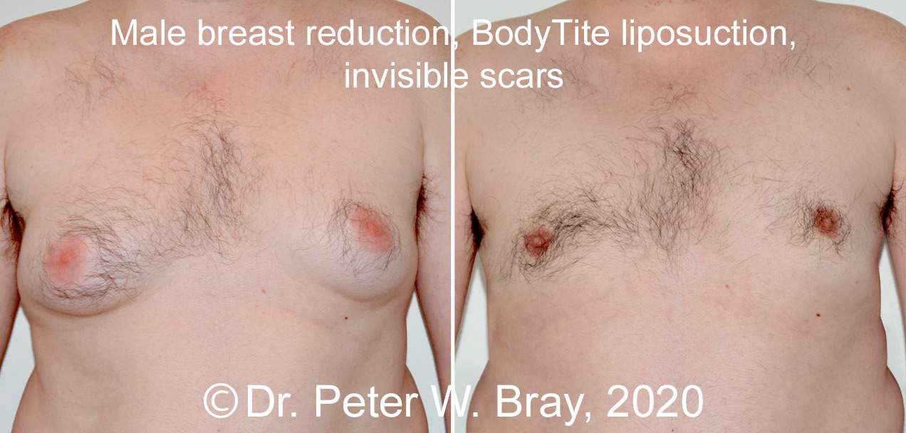 Male Breast Reduction - Before and After Gallery – Photo 6
