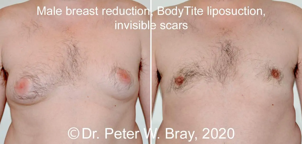 Male Breast Reduction - Before and After Gallery – Photo 6