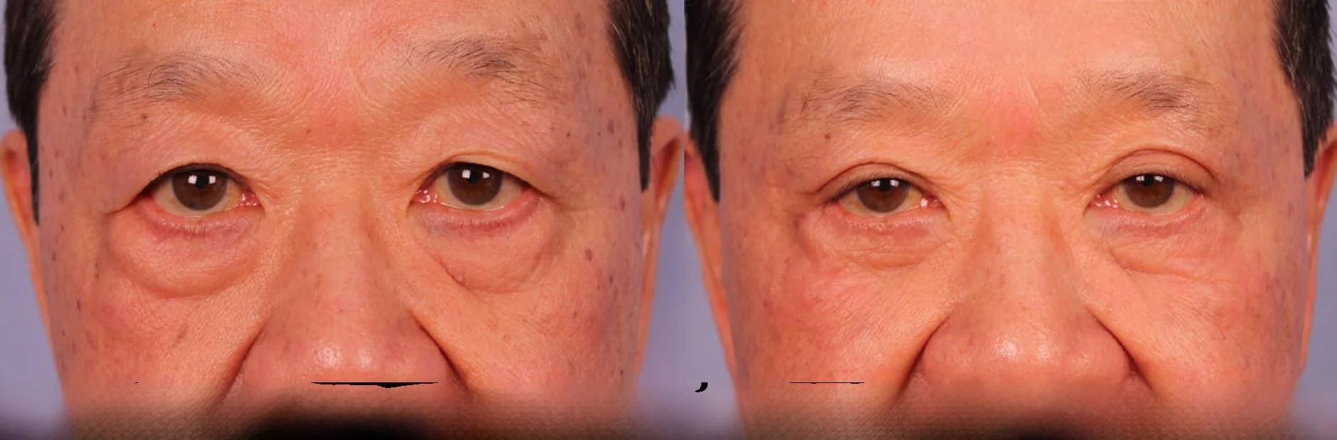 Male Blepharoplasty - Before and After Gallery – Photo 7