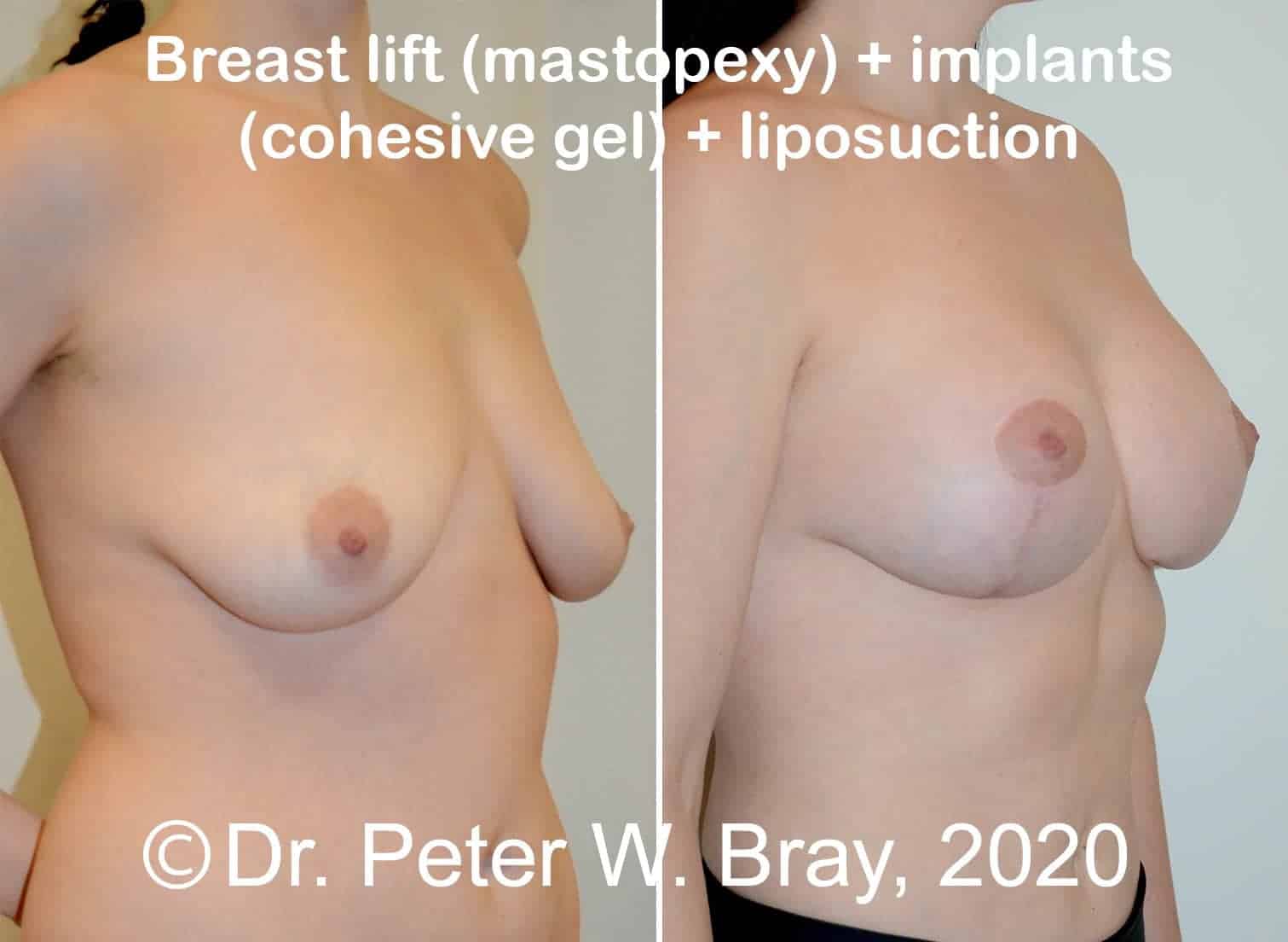 Breast Lift - Before and After Gallery – Photo 8