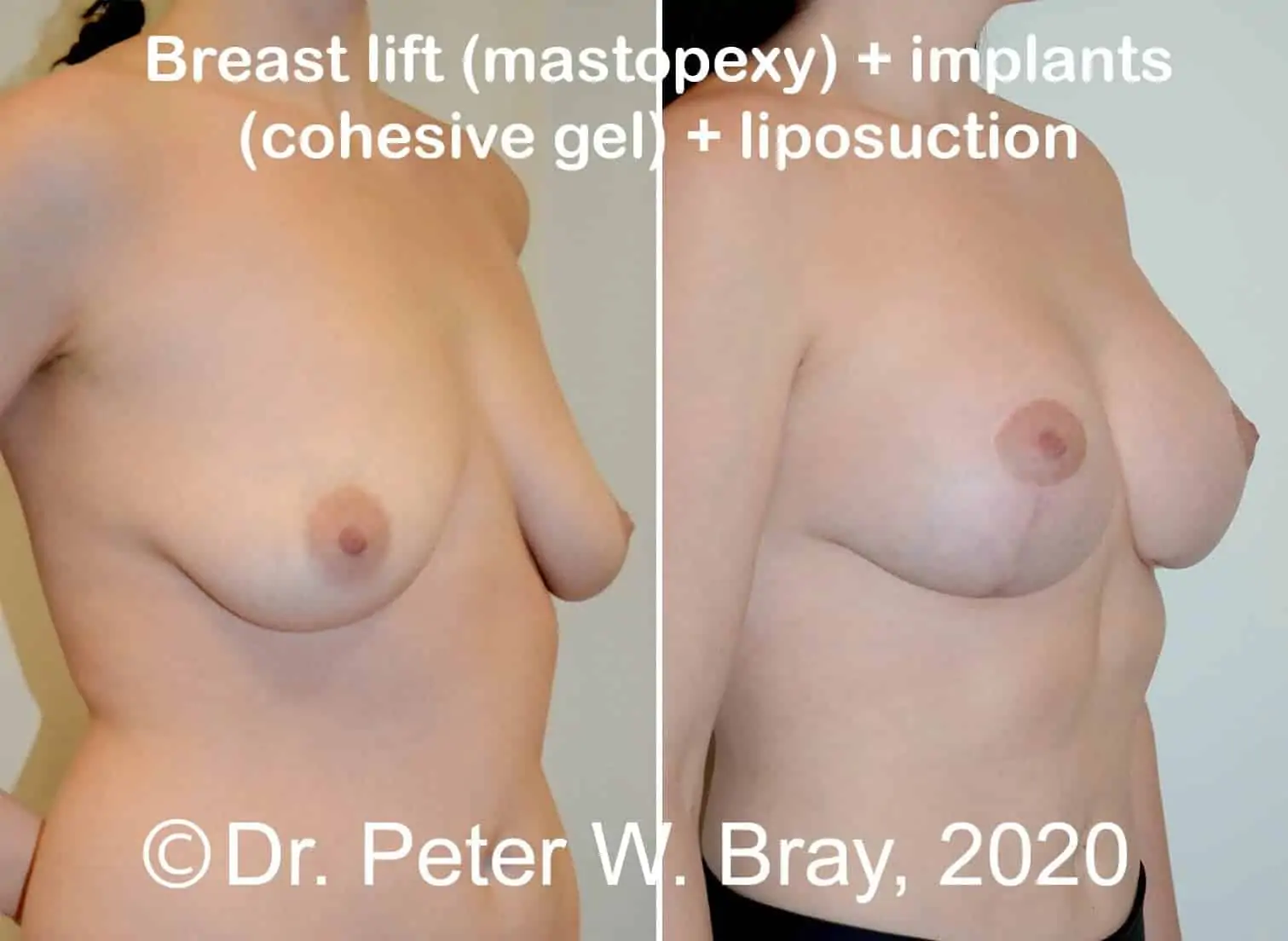 Breast Lift - Before and After Gallery – Photo 8