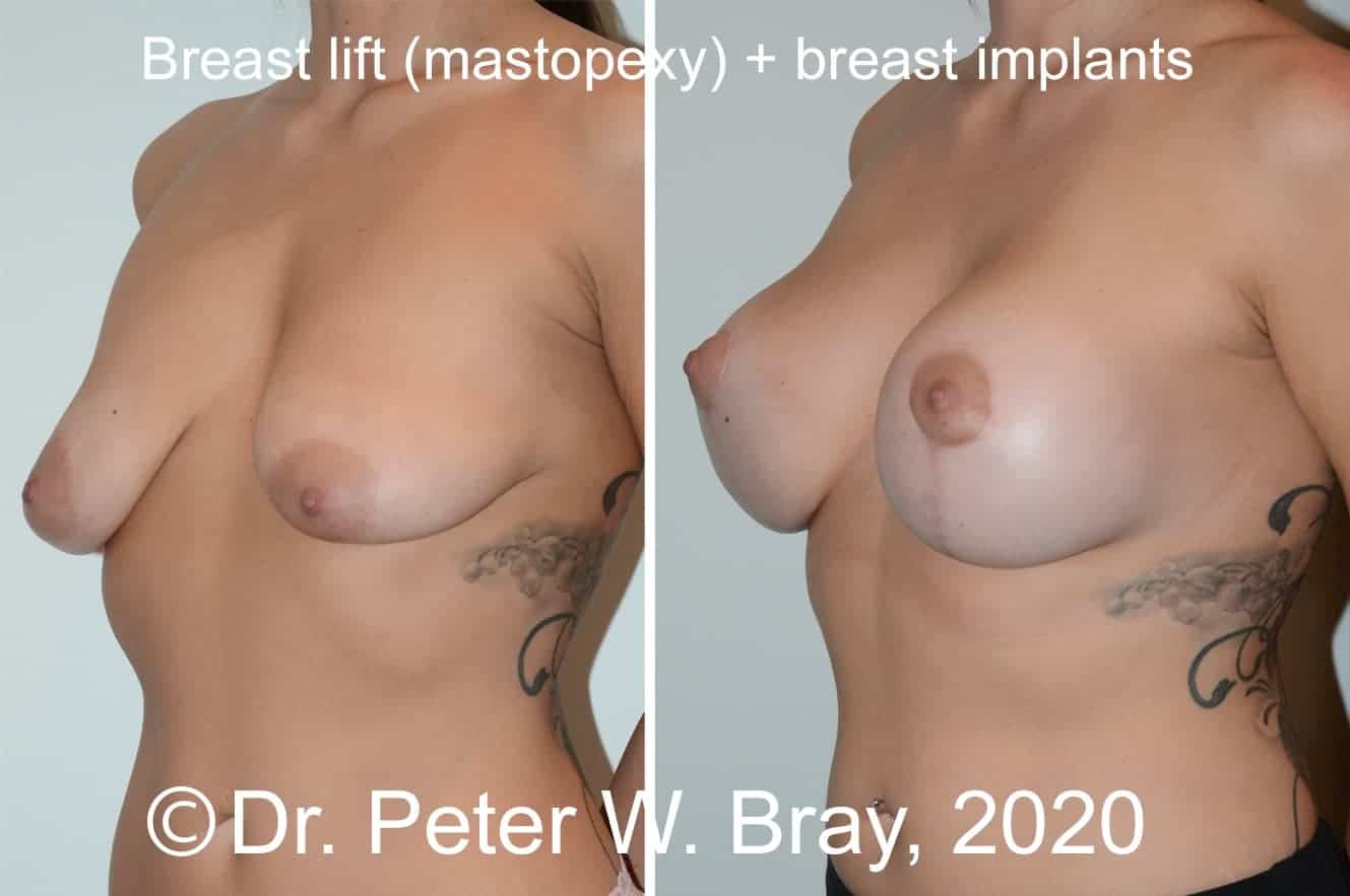 Breast Lift - Before and After Gallery – Photo 9