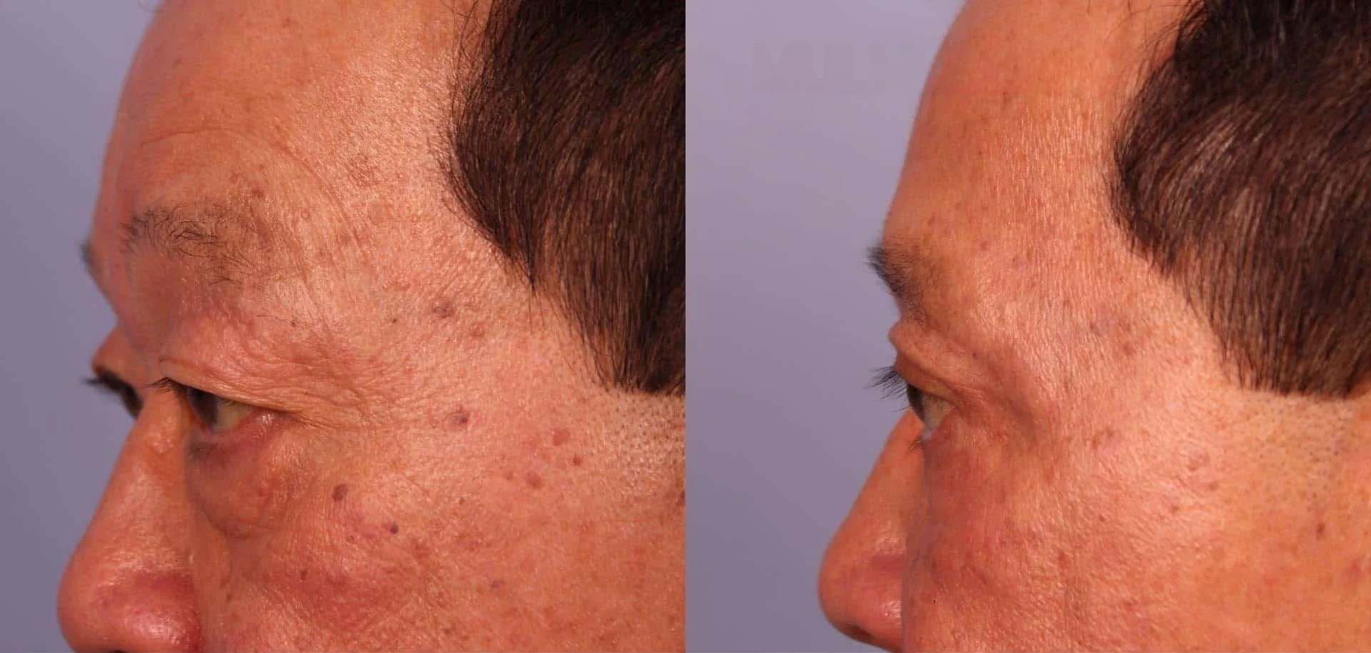 Male Blepharoplasty - Before and After Gallery – Photo 9