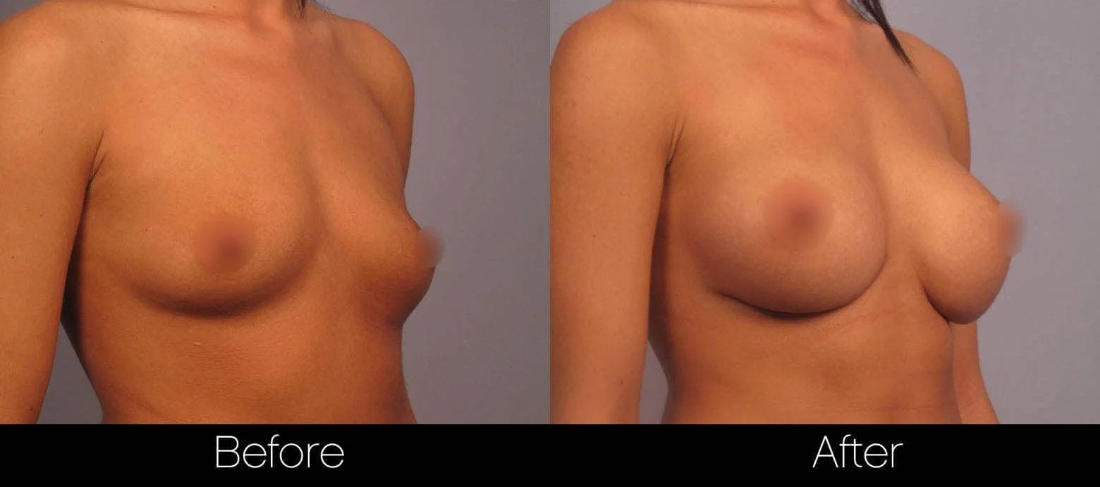 Before and after photos showcasing the results of natural-looking breast augmentation.