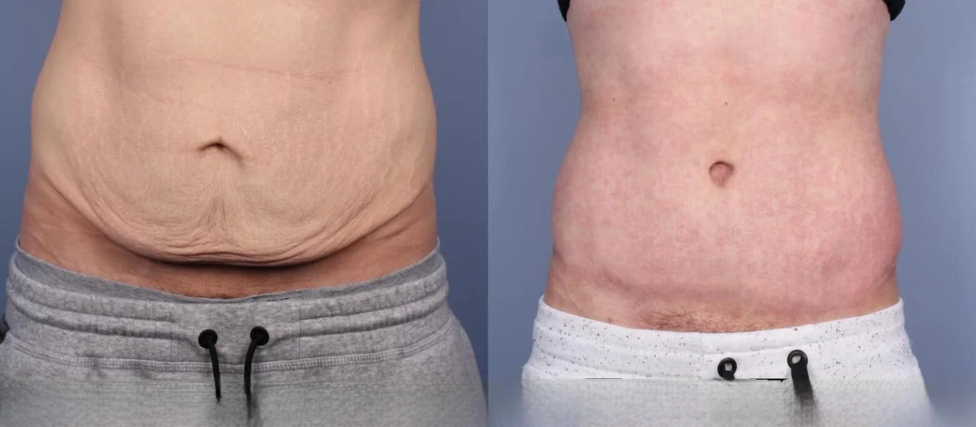 tirzepatide onset of appetite suppression What to Know Before Starting Tirzepatide for Medical Weight Loss tirzepatide onset of appetite suppression What to Know Before Starting Tirzepatide for Medical Weight Loss