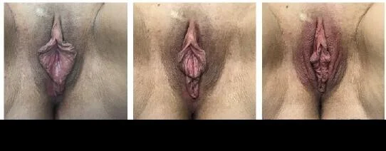 Vaginal Rejuvenation - Before and After Gallery – Photo 1