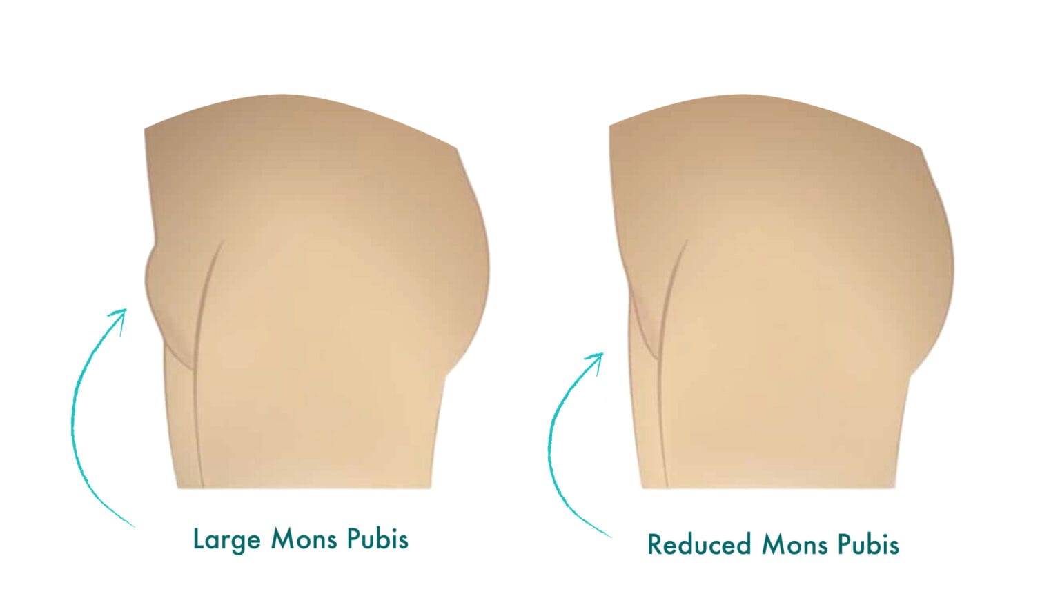 How To Get Rid Of Fupa Fat