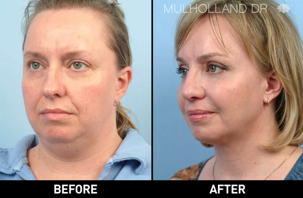 facial fat grafting before and after