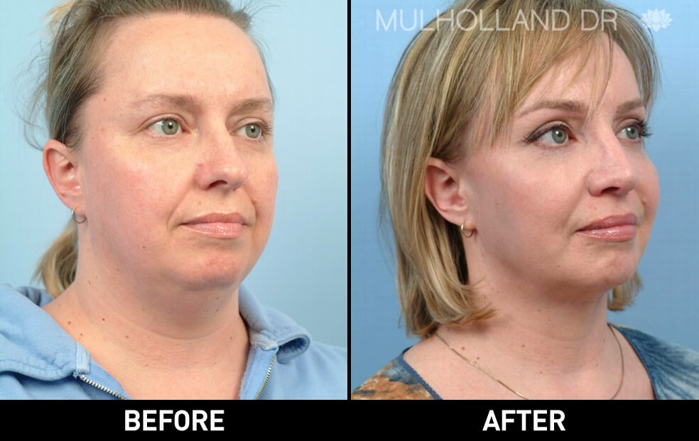 facial fat grafting before and after