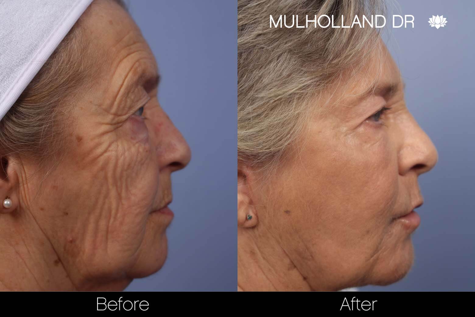 facial fat grafting before and after