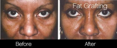 facial fat grafting before and after