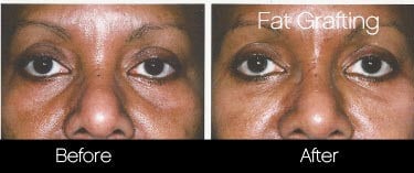 facial fat grafting before and after