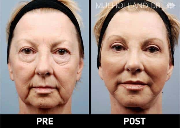 facial fat grafting before and after