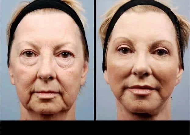 facial fat grafting before and after