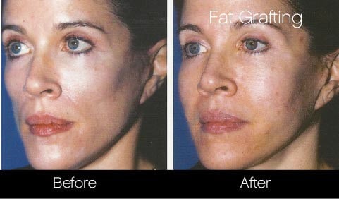 facial fat grafting before and after