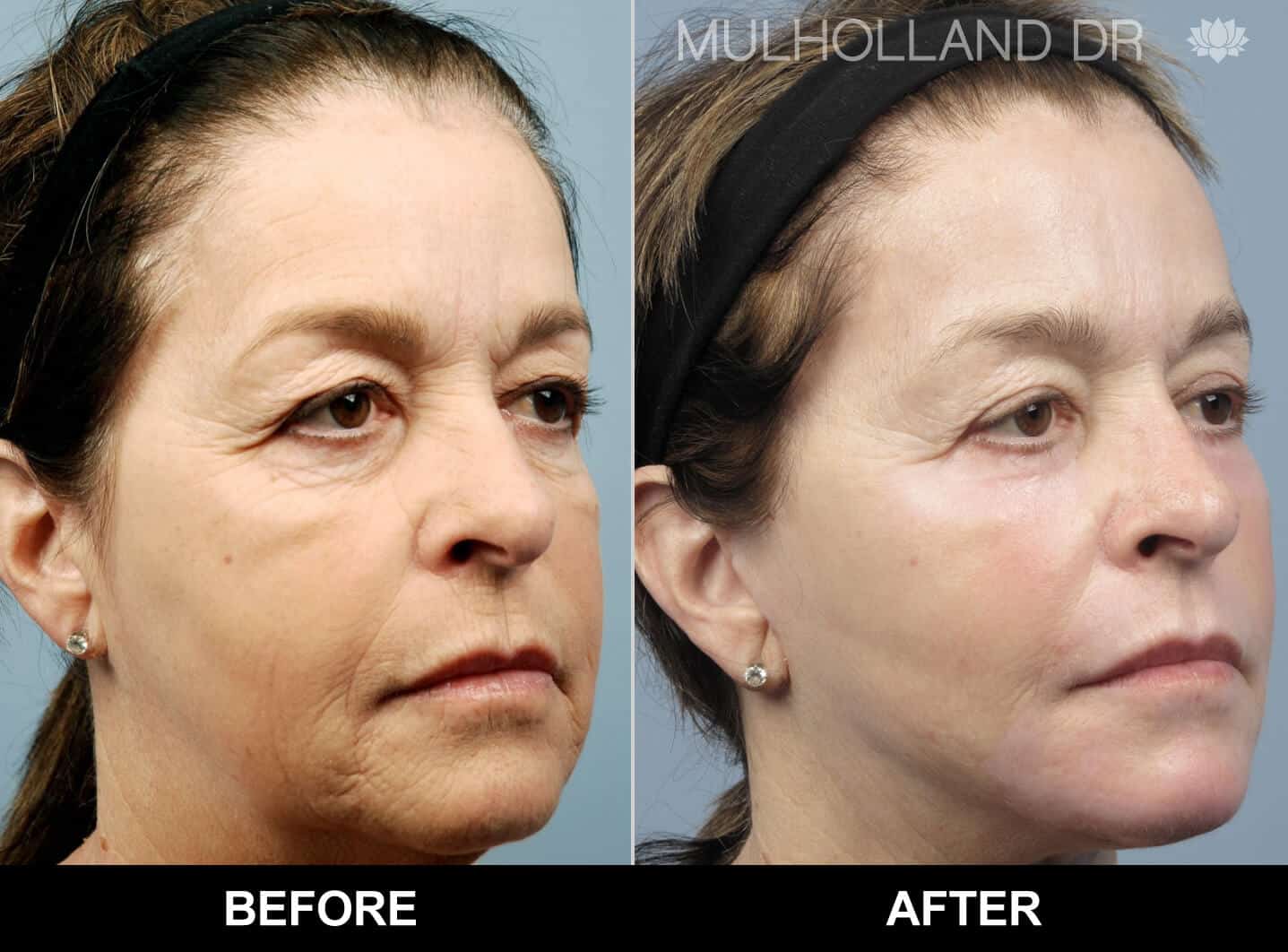 facial fat grafting before and after