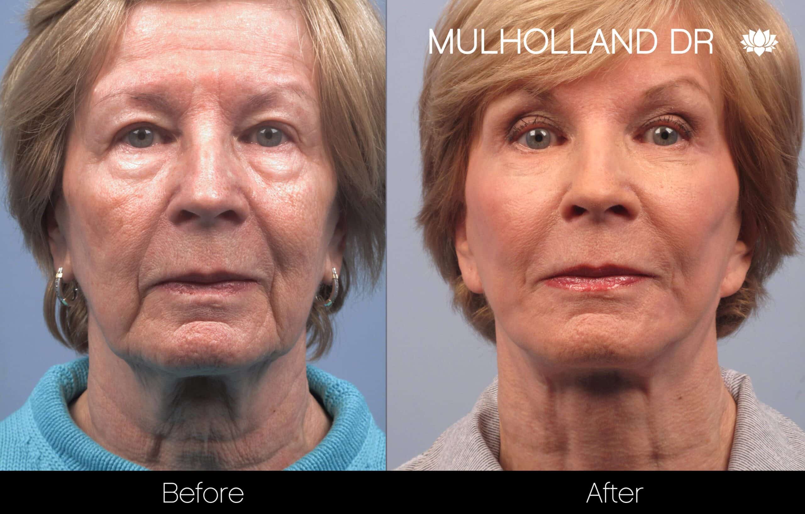 facial fat grafting before and after