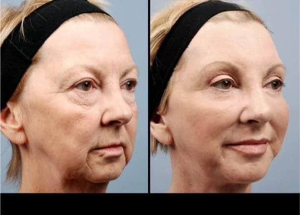 facial fat grafting before and after