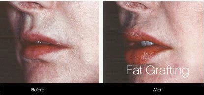 facial fat grafting before and after