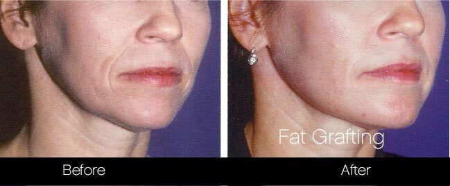 facial fat grafting before and after