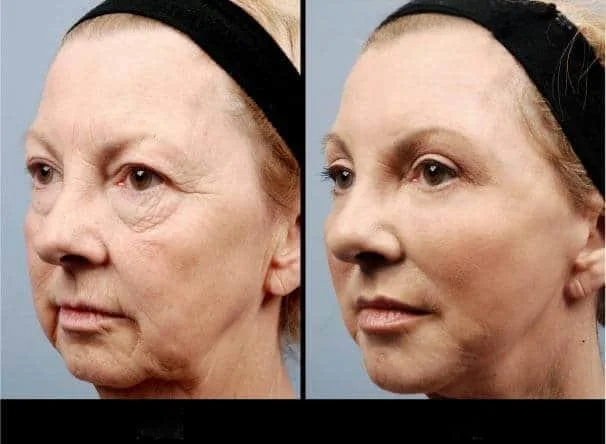 facial fat grafting before and after